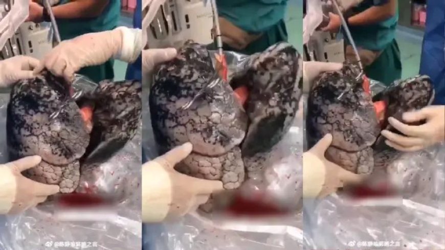 30 वर्षो तक लगातार पी सिगरेट,फेफड़े का हाल देख चौक जाएंगे आप!!